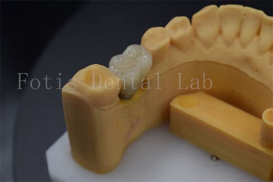 Coronas de implante dental cómodas y duraderas para restaurar los dientes perdidos