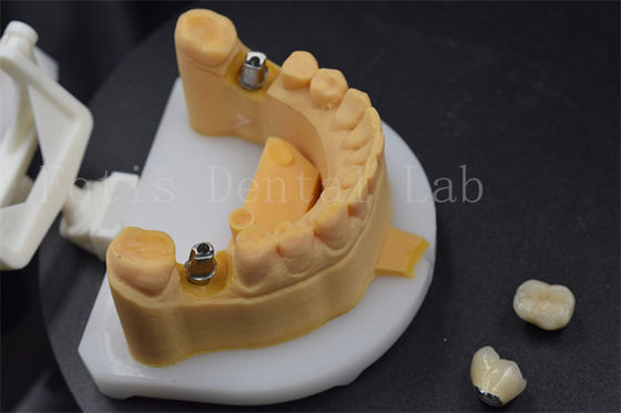 Fácil de colocar corona de dientes de zirconia corona de titanio para dientes personalizados
