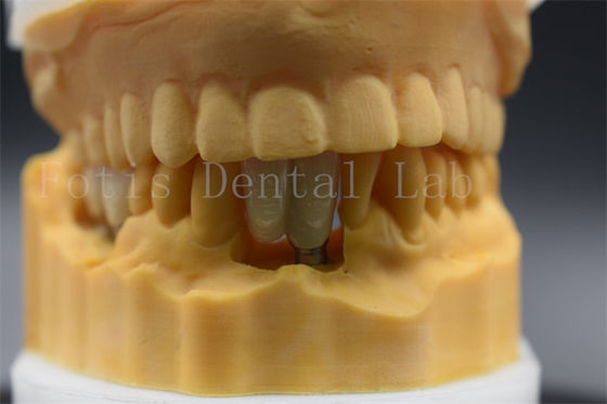 Implante dental hecho a medida Corona de precisión adecuada para dientes faltantes