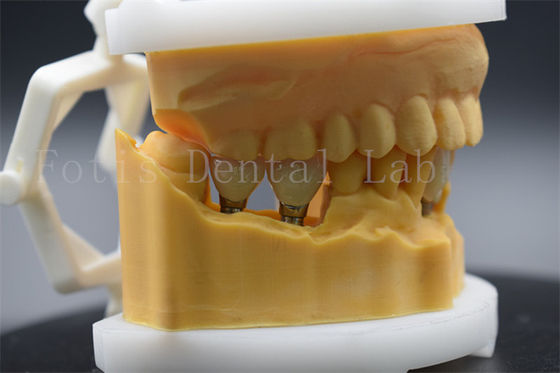 Corona dental de titanio de precisión para implantes dentales fácil de limpiar y mantener