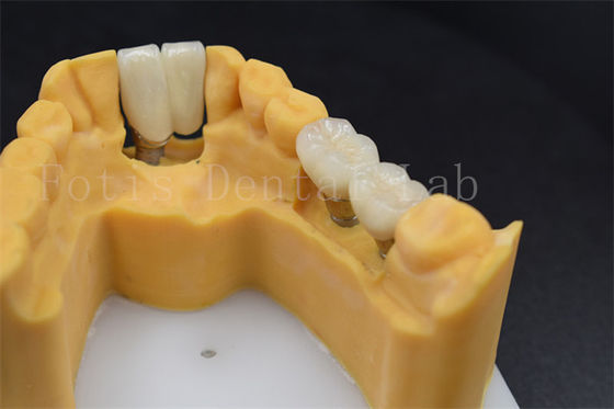 Restauración dental personalizable Implante de reemplazo de corona Varios tamaños