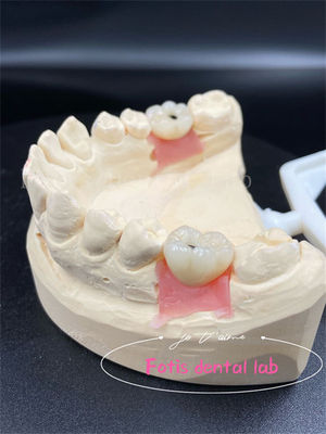 Personalización de las coronas de laboratorio dentales de titanio/ciconía/PFM