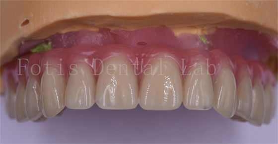 Comodidad del paciente Coronas dentales personalizadas de titanio pulido/zirconio/corona de implante PFM