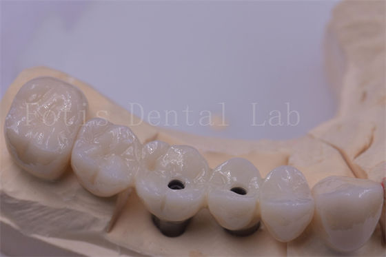 Coronas dentales de titanio / zirconio de plata pulida para dientes faltantes