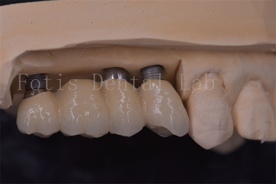 Coronas de implantes dentales de ajuste preciso Titanio / Zirconia / PFM Restaurar dientes perdidos