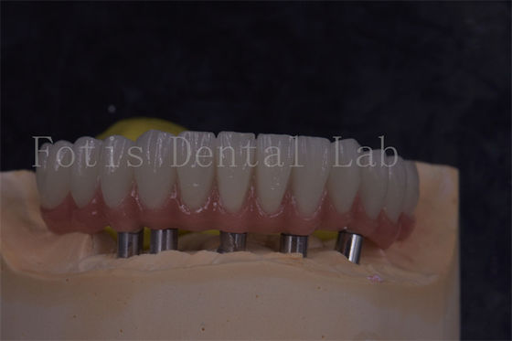 Coronas de implantes dentales personalizables para una apariencia natural y restauraciones cómodas