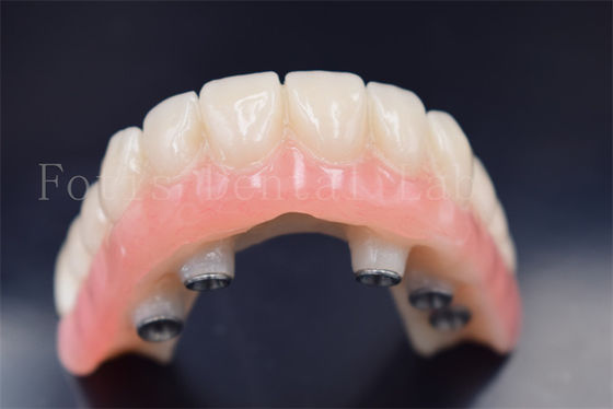 Implantes dentales personalizados Coronas de reemplazo Resistencia al desgaste