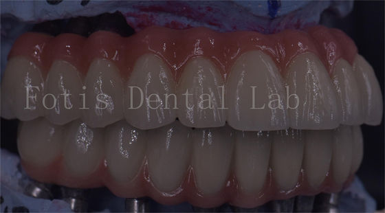Servicio OEM Implante dental duradero Corona temporal Fácil mantenimiento