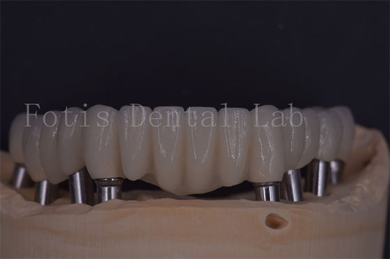Coronas confiables para implantes dentales para mayor comodidad y funcionalidad