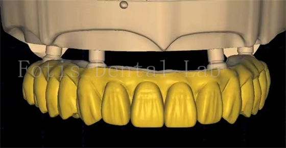 El diseño de las coronas dentales OEM utiliza tecnología avanzada de escaneo e impresión 3D