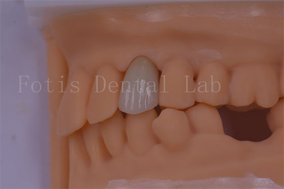 3 Forma/Exo Diseño Coronas dentales digitales mejor ajustadas y menos molestias