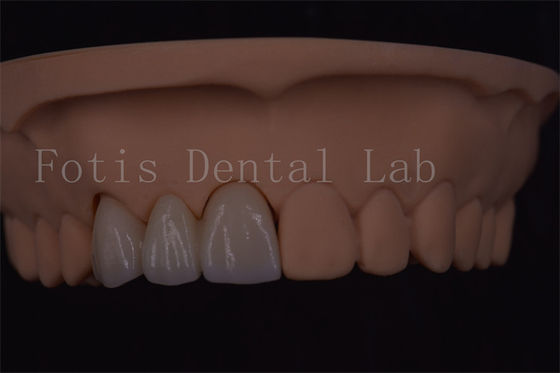 Coronas dentales digitales certificadas ISO para implantes dentales de varios tamaños