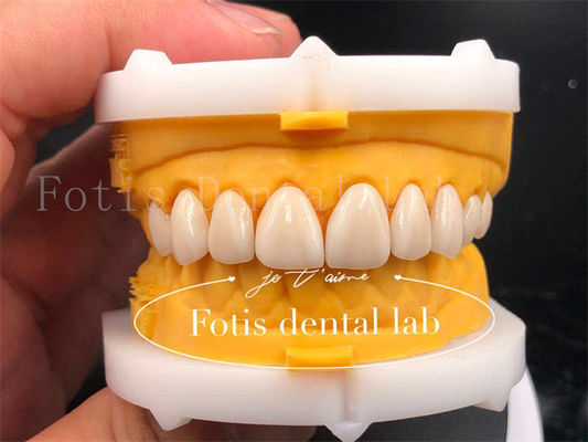 Coronas dentales digitales rápidas y eficientes tamaño personalización de la corona de implantes dentales