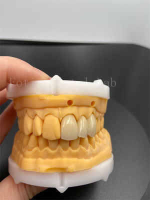 Coronas digitales de ajuste de precisión con implantes dentales con modo de transmisión de correo electrónico compatible
