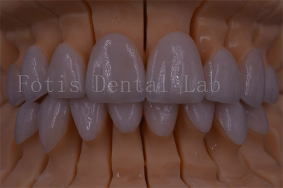Dentes con corona digital certificada por la FDA/ISO/CE Corona artificial de cualquier tamaño