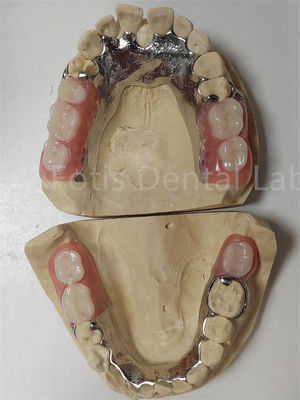 Personalización Dentes parciales temporales compatibles con los dientes naturales