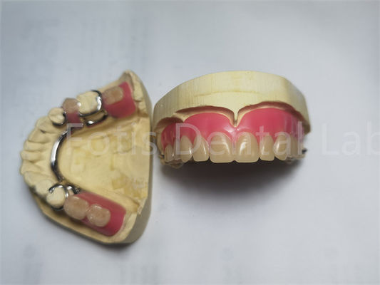 Prótese dental extraíble personalizada