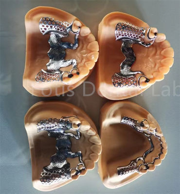 Dentadura parcial flexible extraíble con estabilidad duradera y confort ajustable