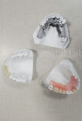 Dentadura parcial removible y flexible de larga duración, fácil limpieza, reemplaza los dientes perdidos