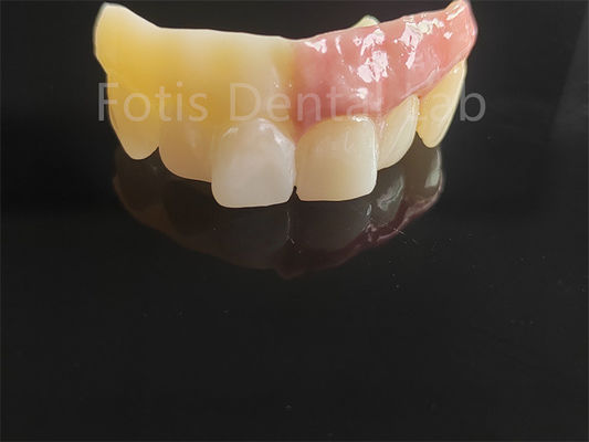 Monolito de zirconia en capas con porcelana diseñado por ordenador