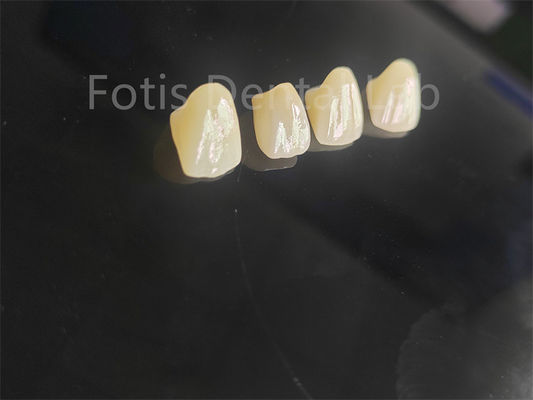 Porcelana de calidad profesional Zirconia fundida para restauraciones dentales perfectas