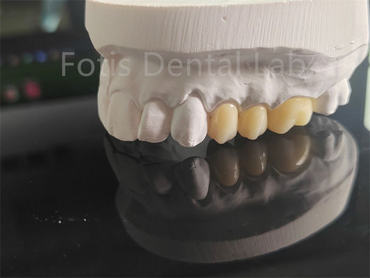 Circonia de porcelana de alta resistencia para coronas dentales