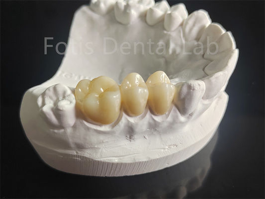 Resistencia al desgaste Zirconia revestida con material dental de porcelana