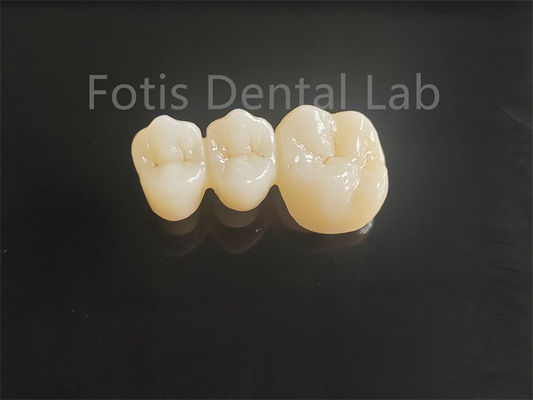Zirconia de porcelana con capas de alta resistencia para puentes dentales duraderos