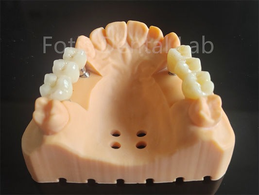 Circonia de contorno completo personalizada con capas de material dental de porcelana