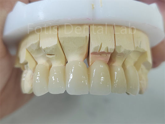 Productos dentales de zirconia con capa de porcelana de fácil mantenimiento