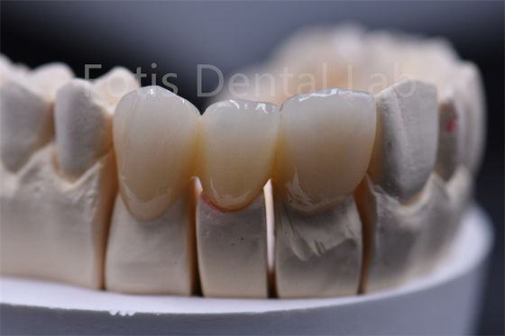 Material dental de cerámica de zirconia de espesor multicapa personalizable