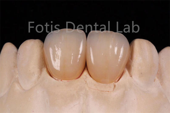 Circonia de alta translucidez de múltiples capas para la fabricación de restauraciones dentales