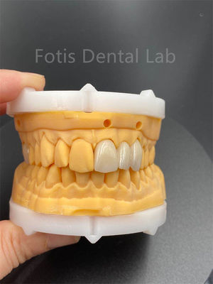 Cerámica dental de zirconia multicapa de alta durabilidad para productos médicos de laboratorio dental