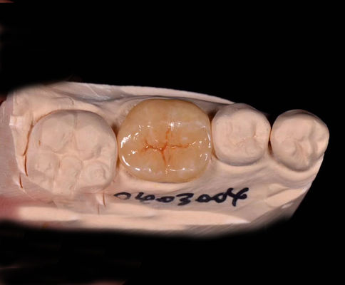 Inlays y onlays hechos a medida, de porcelana e inlays indirectos, con superposiciones dentales