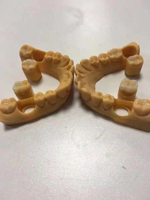 Inlays y onlays de cerámica dental confiables y precisos personalizables