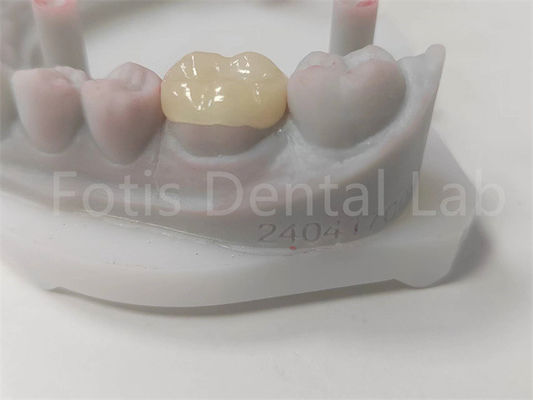 OEM Dental Inlay y Onlay Restauración de cerámica y relleno de color dental