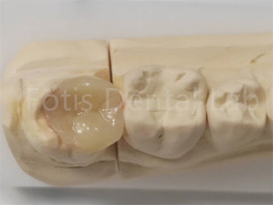 Incrustación y incrustación estéticas en odontología para el relleno indirecto y la restauración dental