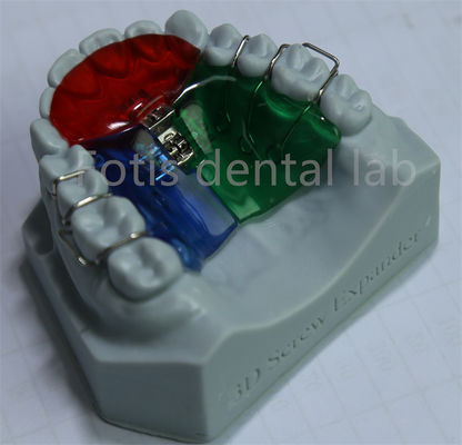 Expansión ortodóntica personalizable y ajustable para una retención efectiva de los dientes