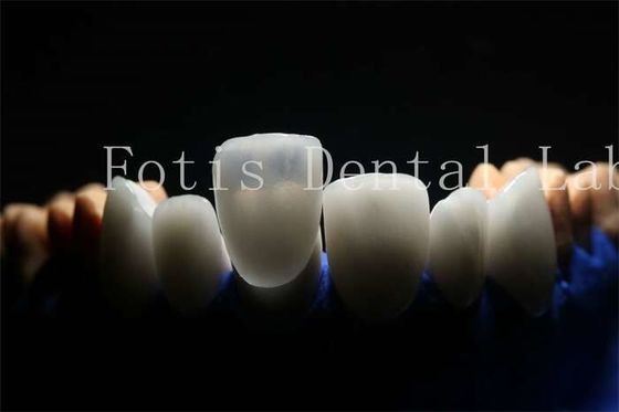 Long-Lasting and Durable Prosthetic Laminate Veneers with Porcelain Material