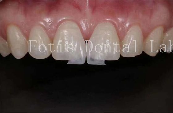 High Translucency Dental Lab Laminate Veneers for Natural and Polishing