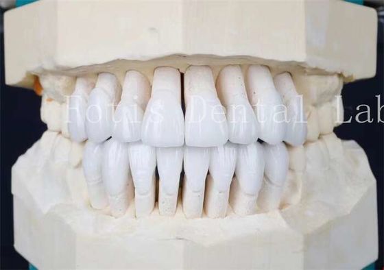 Adhesive Bonding Cement and High Strength Synthetic Laminate Veneers The Perfect Pair