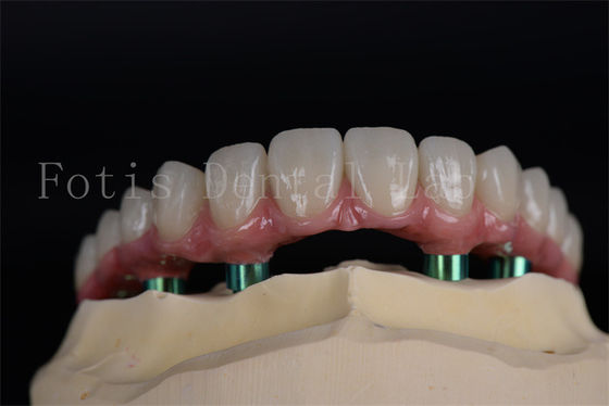Durabilidad de los implantes de 4 a 6 implantes de aspecto natural Estética sin límite de edad recuperación