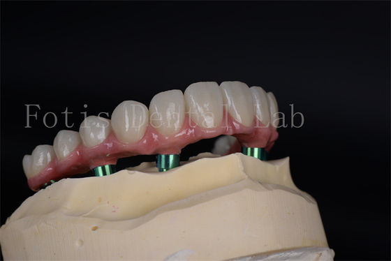 Advanced Full Chewing Ability Restoration Implant Procedure for Low Bone Density Patients