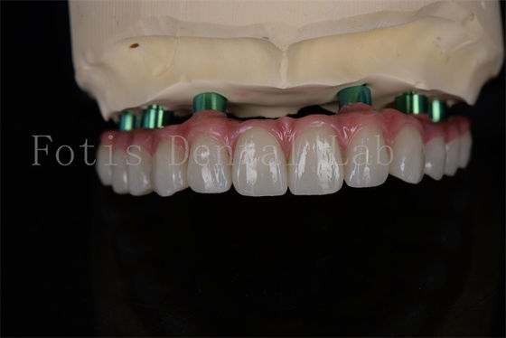 Zirconia All-on-4 Implant Procedure Same Day Recovery Minimal Follow Up Needed
