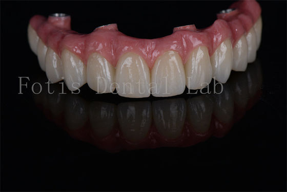 Long-lasting All on 4 All on 6 Dental Implants Minimally Invasive and Easy Maintenance for Low Bone Density Needs