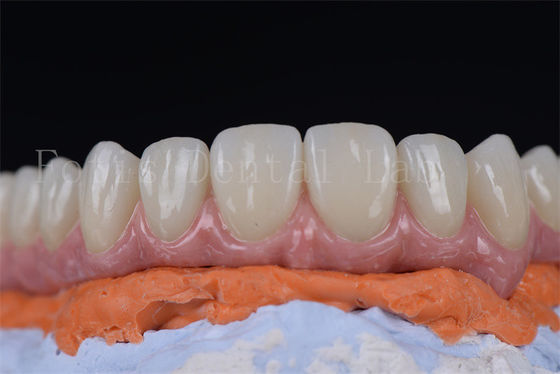 Buen precio Innovador y mínimamente invasivo, todo en 4 y todo en 6 implantes dentales en 1-2 semanas. en línea